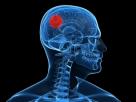 Detección de tumor cerebral