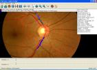 Software analizador de imaxes de retina